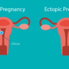 Ectopic-Pregnancies1-300x157